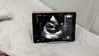 Draadloze echografiesonde met dubbele kop voor hart- en POCUS